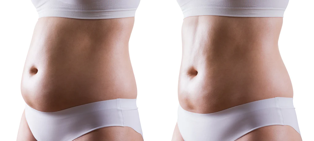 Before and after image showing a toned stomach, highlighting the results of effective spa treatments.