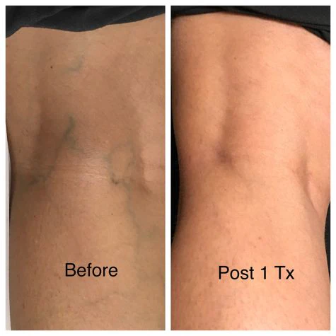 Before and after treatment images showing improved skin texture and reduced visibility of veins on the leg.