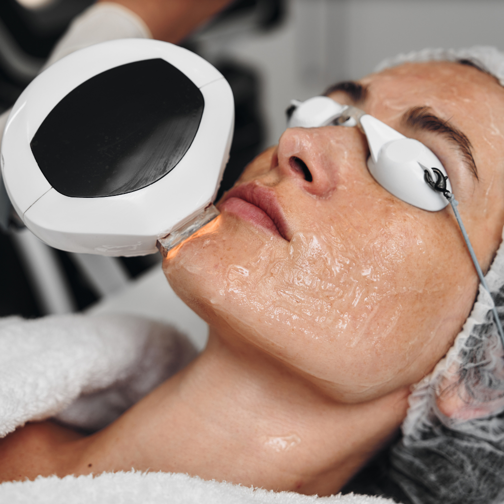 IPL photofacial skin treatment.